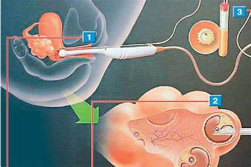 无痛取卵流程