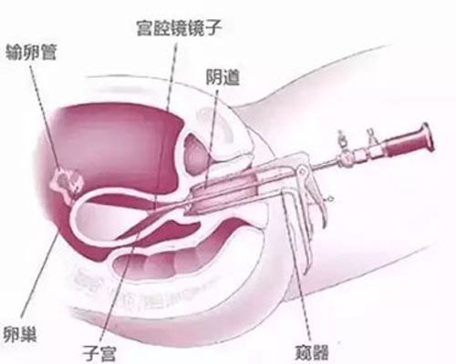 腹腔镜检查