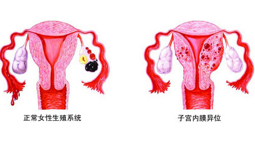 子宫内膜异位