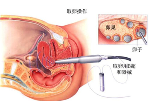 美国试管婴儿取卵