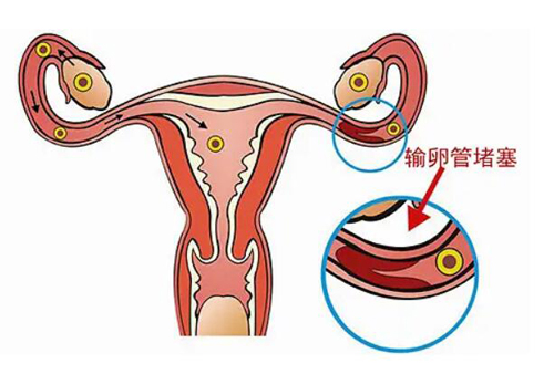输卵管性不孕